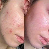 قبل وبعد • بكج ثلاثي • فلر