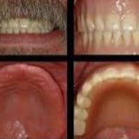 تعويض اسنان • طقم متحرك • مجاناً