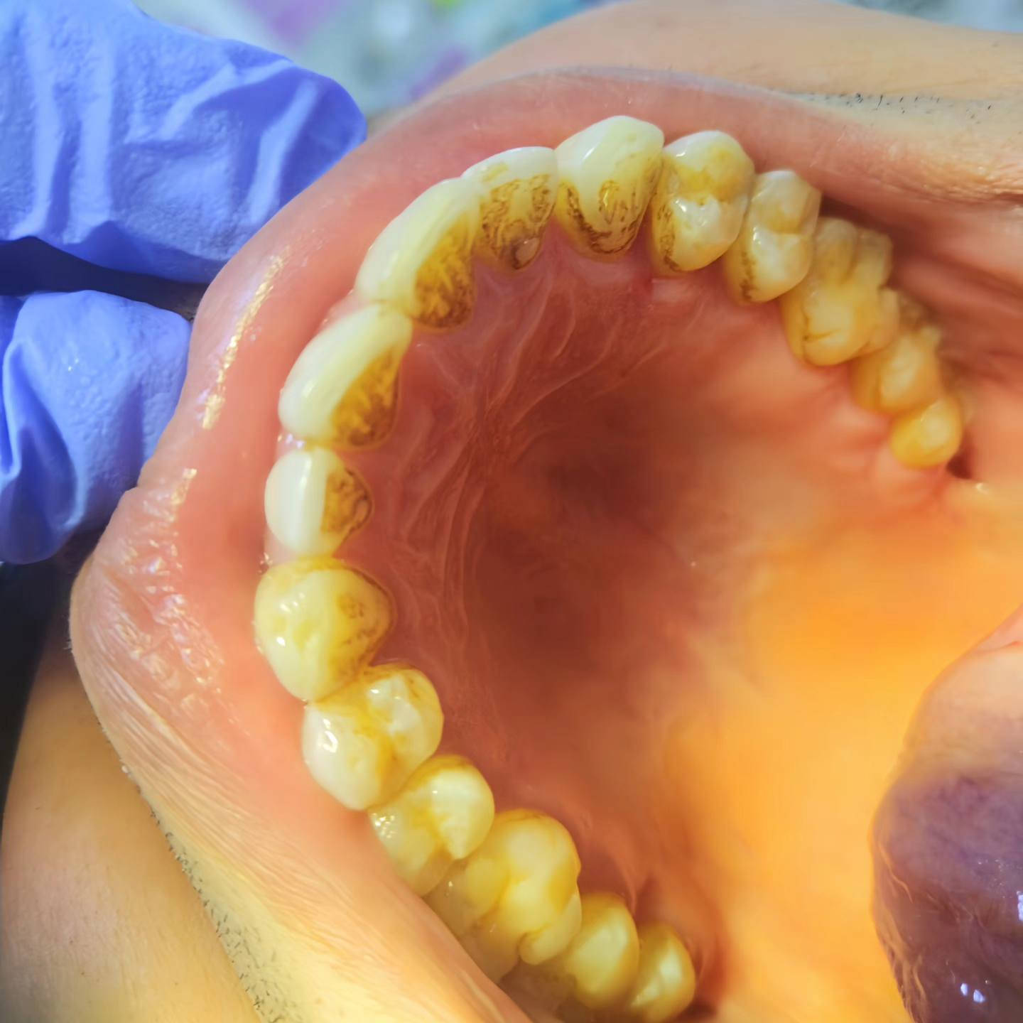 السلام عليكم

متوفر عدنا كافة علاجات الاسنان مثل
* الحشوه الضوئيه (التجميليه)
* تنظيف الاسنان وازالة التكلسات والتصبغات
* تعويض الاسنان المفقودة بطقم متحرك
* ازالة اسنان العقل
* ازالة الجذور التالفه(الي بقائها ممكن يسبب التهاب بالمكان او ممكن لتهيأة المساحه للزرعات المستقبليه)

🦷 العلاج مجاني وتحت اشراف كادر مختص
🦷 الموقع كلية الرشيد الجامعة

✨ زرعات الاسنان متوفره بس مو من ضمن العرض ومو بنفس الموقع اني بس اوصلكم للدكتور المناسب وبأسعار مناسبه للاستفسار عالخاص

🦷 *********** 
🦷 يوزر تيليغرام gagz_7
