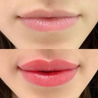 ✨ توريد الشفاه في مركز عشتار بيوتي ✨  احصلي على شفاه وردية طبيعية وجذا...