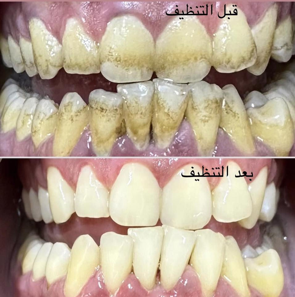 مجانا مجانًا
🛑 تنظيف الاسنان وازاله التكلسات والتصبغات  
 
♦️الوقاية من التهاب اللثة.�♦️الحصول على نَفَس منعش، وذلك بالوقاية من تكون البكتريا المسببة للروائح الكريهة.�♦️الإقلال من تكون التصبغات الخارجية على أسطح الأسنان.

للتواصل والاستفسار اكثر مراسله الصفحه
واتساب ***********
