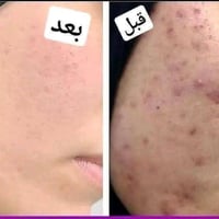 خلطة تبيض • كلف نمش • توصيل