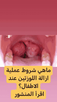 أهم أسباب  استئصال اللوزتين عند الأطفال 

اولا
 هو تضخم حجمهما حيث تسبب : 
الشخير  أثناء النوم  

ثانيا
 صعوبة وانقطاع التنفس أثناء النوم . 
و هذا بعد عدم استجابة العلاج  بالأدوية

ثالثا
وجود تاريخ عائلي بالتهاب اللوزتين المزمن من جهة الاب او الام

رابعا
التهاب اللوزتين خمس مرات فما فوق خلال السنه

خامسا
الشكوى المزمنه من مغص البطن او الم في مفصل الركبتين للطفل

في الصورة  حجم اللوزتين كبير جدا حيث تؤثر  على التنفُّس و البلع

دمتم واطفالكم بألف خير

الدكتور
احمد محمود عبدالله
طبيب الأطفال والخدج وحديثي الولادة

العنوان
بغداد حي الحسين مجمع التقى الطبي قرب مجمع النمور مقابل كوزمتك الفرج

للحجز والاستفسار
*********** 

👍❤️ لاتنسو المشاركة والاشارة للاصدقاء
لنشر المعلومة الطبية الصحيحة وتعم الفائدة للجميع...
