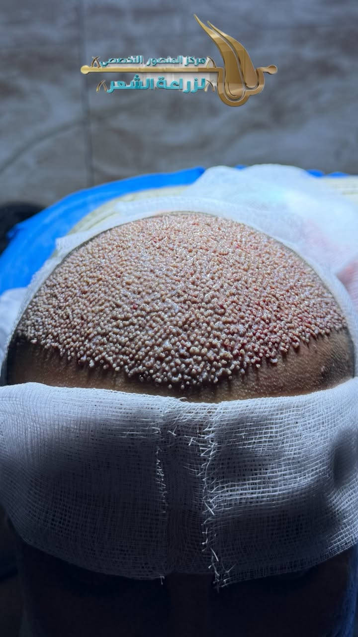 نفس اليوم… وبعد ما خلصنا العمليات مباشرة
شوفوا الكثافة شلون مرتبة وواضحة من أول لحظة

توزيع دقيق✅
فتح قنوات مدروس✅
وعدد بصيلات مضبوط حتى يطلع الشكل ممتلئ من البداية✅

هاي مو وعود… هاي صورة بنفس اليوم 📸
والكثافة الواضحة تبدي من عدنا 🤫🫵🏻

للحجز والاستفسار 
***********

او زورونا بموقع العياده 
بغداد المنصور شارع الرواد مقابل مرطبات مشمشه
