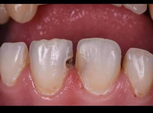 السلام عليكم اخواني
الي محتاج حشوات باسنانه الامامية بسبب كسر او تسوسات مثل الي بالصورة خل يراسلني او يعلق
*********** واتساب تلغرام
