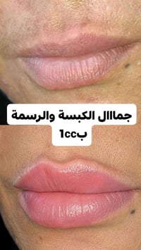 جمال الرسمة والكبسة فقط ب1cc من الفلر الايطالي  للحجز والاستفسار دايرك...