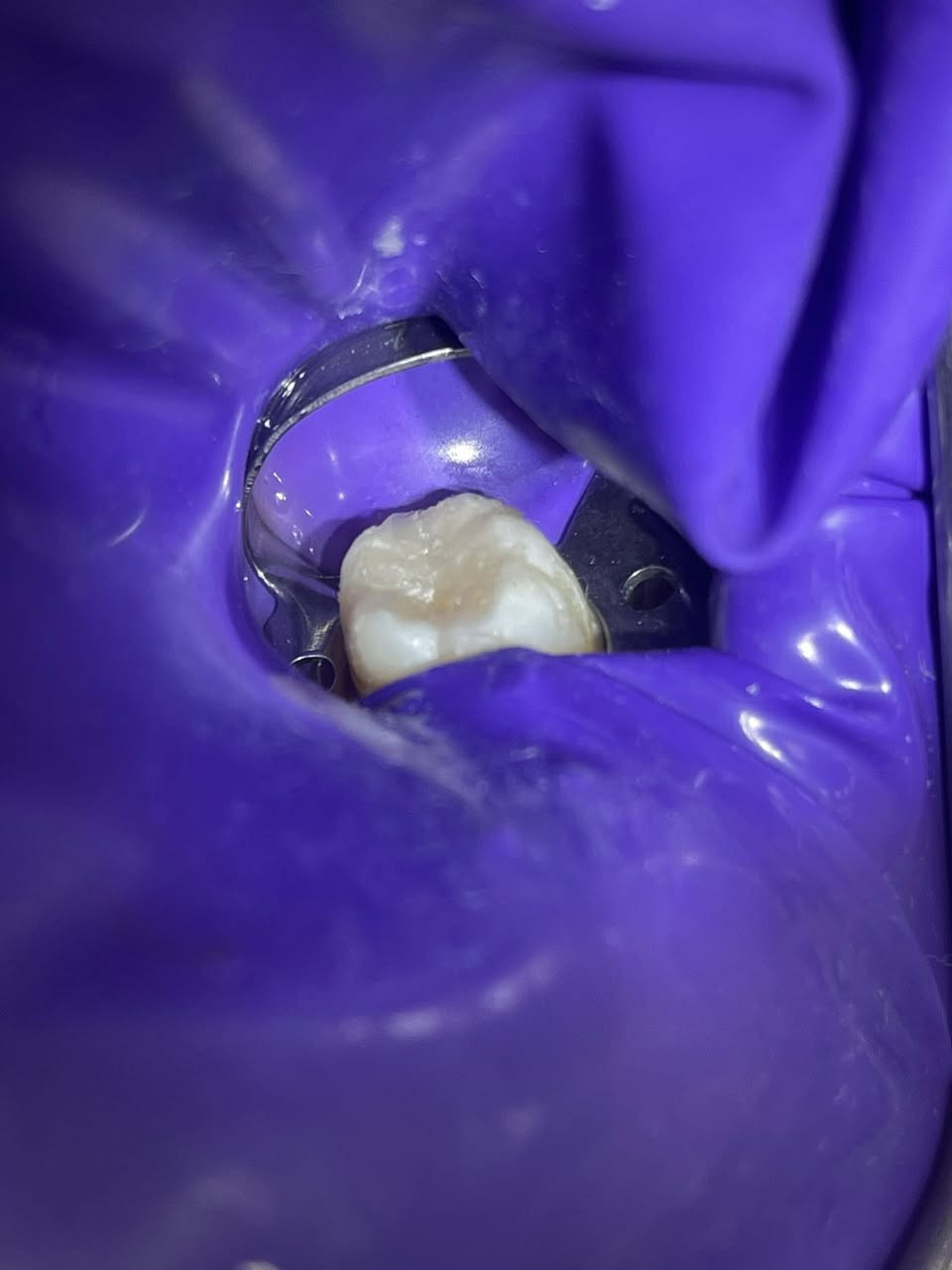 السلام عليكم 
اي شخص محتاج علاج لاسنانه خلي يتواصل وياي 
حشوات ضوئية وتجميلية  
تنظيف وتبيض الاسنان 
قلع الاسنان والجذور التالفه 
تركيب وتعويض الاسنان المفقوده 
***********
علماً ان العلاج مجاني لفتره محدوده
