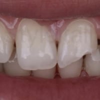 حشوات تجميلية • قلع جذور • الحلة شارع اربعين