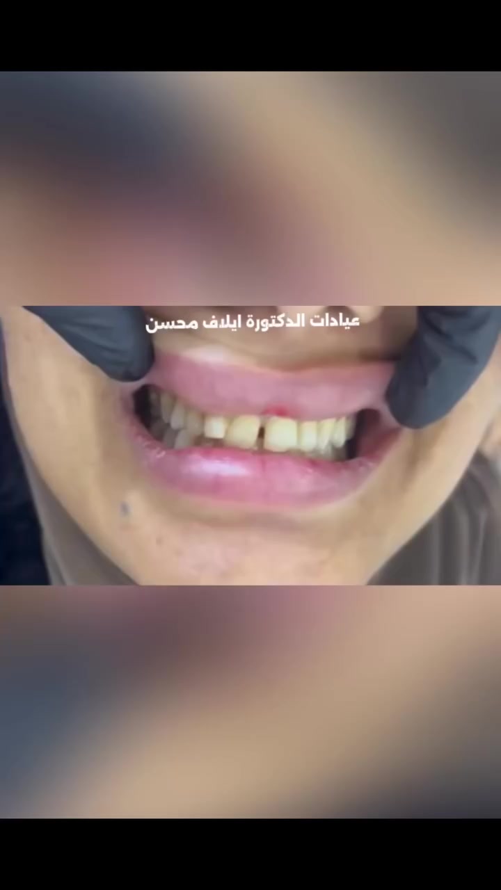 هل تبحث عن التغيير الحقيقي؟ ابدأ من الطبيب الصح! 🦷✨
​قشرة الإيماكس ليست مجرد قطعة سيراميك، بل هي فن يحتاج ليد خبيرة تبرز جمال ملامحك. في رمضان، اجعل ابتسامتك هي أجمل ما يراك به الناس.
​كل عام وأنتم بخير بمناسبة شهر رمضان المبارك.
ننتظركم في عيادتنا لنرسم ملامح ثقتكم من جديد.
​🌙 دوام العيادة في رمضان:
يومياً من 7:00 مساءً حتى 12:00 بعد منتصف الليل


**إذا كنت صاحب هذا الإعلان وتريد حذفه لأي سبب، رجاءا أرسل رسالة إلى الدعم الفني**