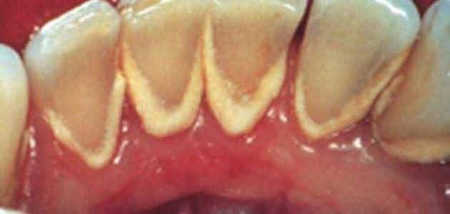 مجانا.
قلع الاسنان التالفه والجذور المتبقيه
حشوات ضوئيه تجميليه 
تنضيف الاسنان 
طقم اسنان متحرك جزئي
علما ان العلاج مجاني 
للتواصل الاتصال على الرقم التالي او التواصل على الواتساب ***********
