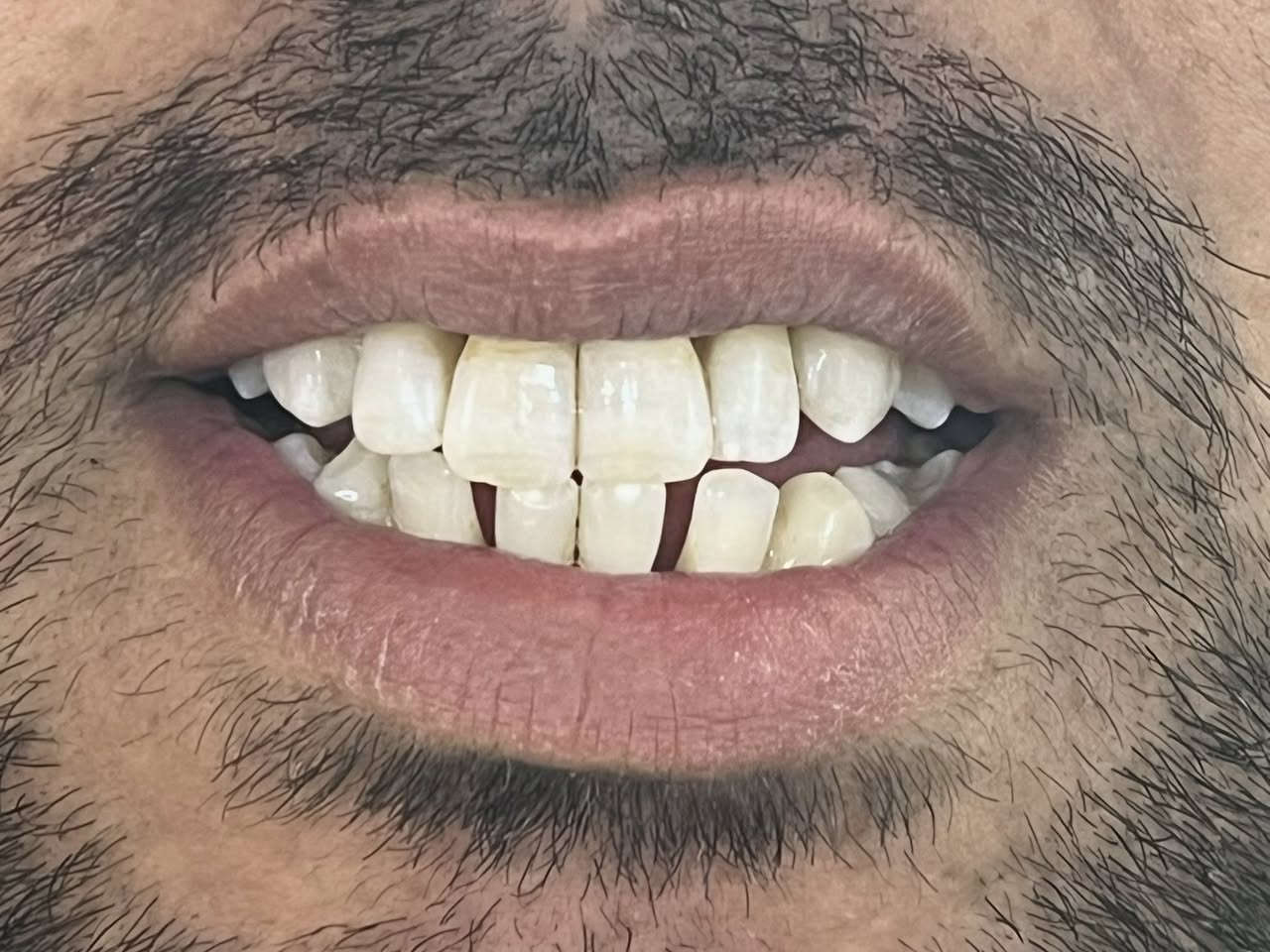 تنظيف أسنان وتلميع ب١٥ الف بس بدل ٢٥ الف

✨ الفرق يبان من أول نظرة!
والصوره تحجيلك عن الشغل وجماله 

إذا أسنانك بيها تصبغات أو جير وتريد ابتسامة أنظف وأجمل، الحل بسيط وسريع 👌

🦷 تنظيف الأسنان وإزالة الجير مع التلميع
يعطيك:
 • أسنان أنظف ولمعة واضحة
 • إزالة التصبغات والتكلسات
 • إحساس بالانتعاش والنظافة

🔥 النتيجة: فرق واضح ومبهر من أول جلسة

📍 في عيادة البيت الطبي
العنوان: بغداد – المحمودية – حي الموظفين – مقابل التانكي 

📅 الحجز *********** من ٣ للفطور 

احجز وخلّي ابتسامتك تحچي عنك
