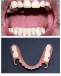 زراعة أسنان مجاني • جامعة المشرق • قلع وحشوات تجميلية