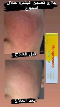 ودّعي الكلف والتصبغات واستعيدي إشراقة بشرتكِ! ✨💜  مع بكج Neoprosone ال...