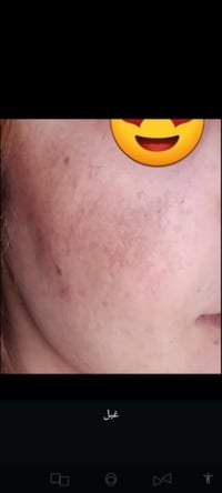 خلطة تبيض • نضارة خلال يومين • توصيل