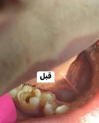 حشوة جذر جلسة واحدة • د محمد منصور • عيادة الفرح