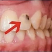 مجانا • حشوة ضوئية • حلة شارع 40