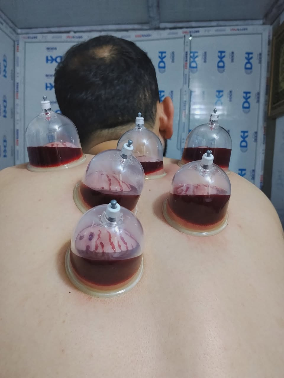 حجامة الشفاء 
حجامة كاملة متكونة من خمسة گلاصات 
السعر 10 الاف دينار 
عنوان المركز 
مركز الشفاء عيادة جبراوة 
***********
