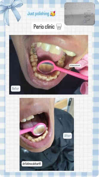 🔴مجاني تماما وتحت إشراف اطباء اختصاص 🔴يتوفر في عيادتنا قلع الأسنان المتحركه واللبنية وبقايا الجذور  من عمر ١٢فما فوق، تعويض الأسنان المفقودة بطقم جزئي متحرك، تنظيف الأسنان من التكلسات والتصبغات حشوات ضوئية للحجز والاستفسار على ***********عيادات جامعه اوروك كرادة 52مجاور مركز شرطه العلويه مقابل مطعم نانار
