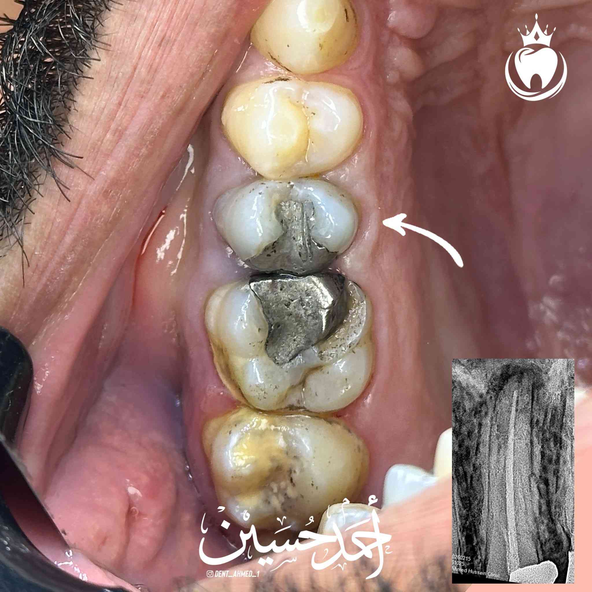 زارنا مراجع عنده ألم بسنه بعد الفحص و الاشعة تبين وجود مشكلة في حشوة الجذر لهذا السن 
حيث تم اعادة حشوة جذر المعمولة بشكل خاطئ لسن ضاحك علوي🦷 
مع وجود التهاب تحت الجذر  نتيجة عدم تحشية كافة قنوات السن 
واستبدال الحشوة المعدنية ب حشوة ضوئية و استعادة وظيفة و شكل السن الطبيعي الشرح تحت الصور  

الدكتور احمد حسين الطعماوي 
المكان : ناحية الزاب -المجمع الطبي الحديث مجاور مرطبات كرزة
للحجز و الاستفسار : ***********
