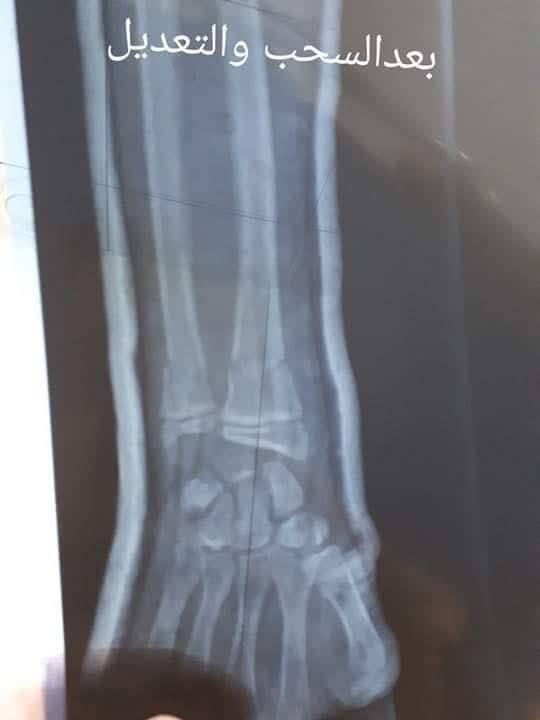 ⌛السلام عليكم⏳

سحب وتعديل لكسر معقد  بدون تداخل جراحي النتيجه 
الحمدلله  
                            الدكتور
                     ياسر يوسف العبيدي 
            اختصاص جراحة العظام والكسور 
البورد العربي( دكتوراه )جراحة العظام والكسور 
#كسور #تبديل_مفصل_الركبة #تبديل_المفصل_الورك #جراحةالعظام🦴_والمفاصل #جراحةالعظام #جراحة_العمود_الفقري #الانزلاق_الغضروفي #ناظور_الركبه #الاصابات_الرياضية #القدم_السكري
# متواجد في عيادته كل ايام الاسبوع عدا يوم الجمعه من الساعه 2:30مساء الي الساعه 5:00 مساء خلال شهر رمضان المبارك
 مجمع وصيدليه محمدسعيدحمدان 
للحجر والاستفسار ***********ك
هيت شارع الاطباء
