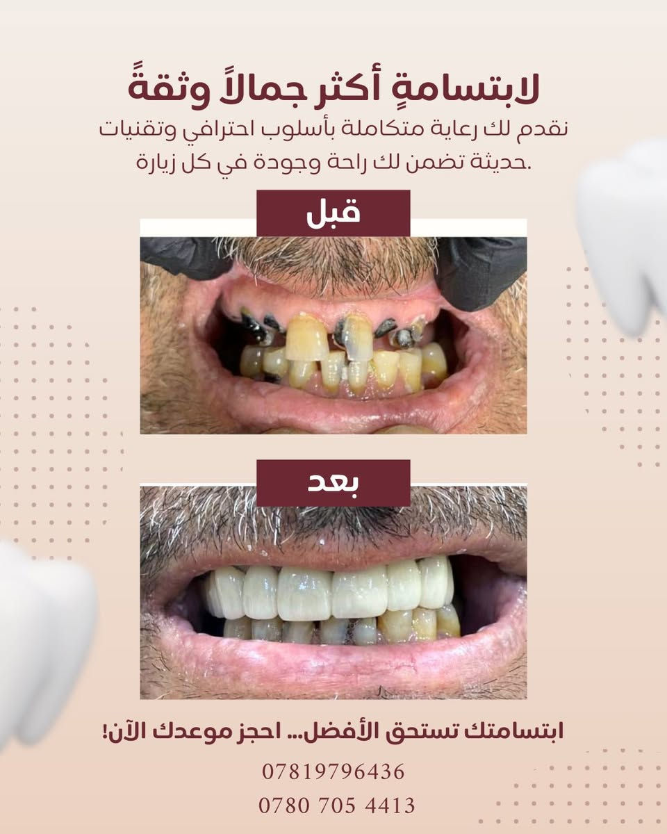 بشرى سارة 🌿

إلى أهالي الغزالية الكرام:

يسرّنا إعلامكم بـ اعلان عروض عيد الفطر المبارك في عيادة طب الأسنان التخصصية د.رسل رعد
 ونعلن عن تخفيض خاص بنسبة 50% ولمدة محدودة يشمل جميع الإجراءات العلاجية:

🔹 الحشوات التجميلية
🔹 حشوات الجذور
🔹 قلع الأسنان الاعتيادي والجراحي
🔹 تقويم الأسنان
🔹 زراعة الأسنان
🔹 تبييض وتنظيف الأسنان

✨ الفحص مجاني

💚تتوفر خدمة العلاج بالأقساط

📍 العنوان: الغزالية – شارع البدالة، مقابل مختبر مختبر اوركيد، مجاور صيدلية صيدلية محمد فليح
📞 هاتف العيادة: ***********
 0780 705 4413
🕓 أوقات الدوام في شهر رمضان المبارك بعد الافطار: من الساعة 7:00 مساءً ولغاية 11:00 مساءً

أهلاً وسهلاً بكم 🌸
صحتكم تهمّنا دائمًا
