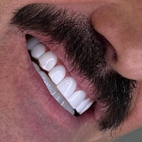 # سعرنا مغري جدا ✨ ابتسامة كاملة بدون برد الأسنان  /عدسات تجميلية بنتي...