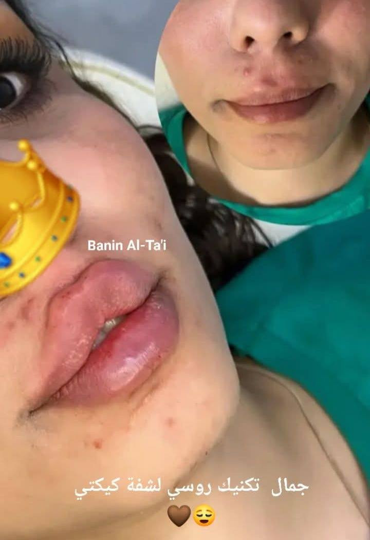 قبل وبعد الحقن لكيكتي شوفو جمال الرسمه الكرزية الروسي 😌👑

كل هذا جمال 75 الف بس


**إذا كنت صاحب هذا الإعلان وتريد حذفه لأي سبب، رجاءا أرسل رسالة إلى الدعم الفني**