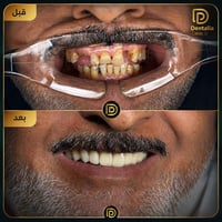 تركيبات ثابتة • إعادة تأهيل أمامي • الكوت الخاجية