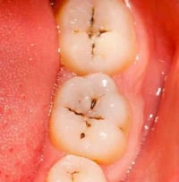 الي محتاج حشوه ضوئيه علماً ان العلاج مجاناً وعنده هيج نوع تسوس يراسلني...