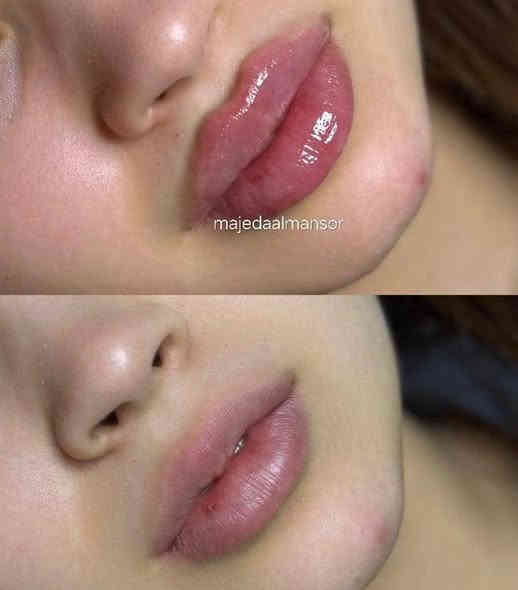 طبيعي – مظهر أنثوي جذاب
💉 جلسات فيلر شفايف بمواد أصلية وآمنة
✔️ تكبير الشفايف بشكل متناسق
✔️ تحديد الحدود بلمسة أنيقة  الدكتورة ماجدة المنصور Jojo Alnabeel
العنوان بغداد الحسينية مقابل السوق الكبير مجاور مرطبات العذراء
مجمع سما الحسينيه للحجز ***********  حساب التيك توك 
https://www.tiktok.com/@ma8j4?_r=1&_t=ZS-915uhyehfWy
