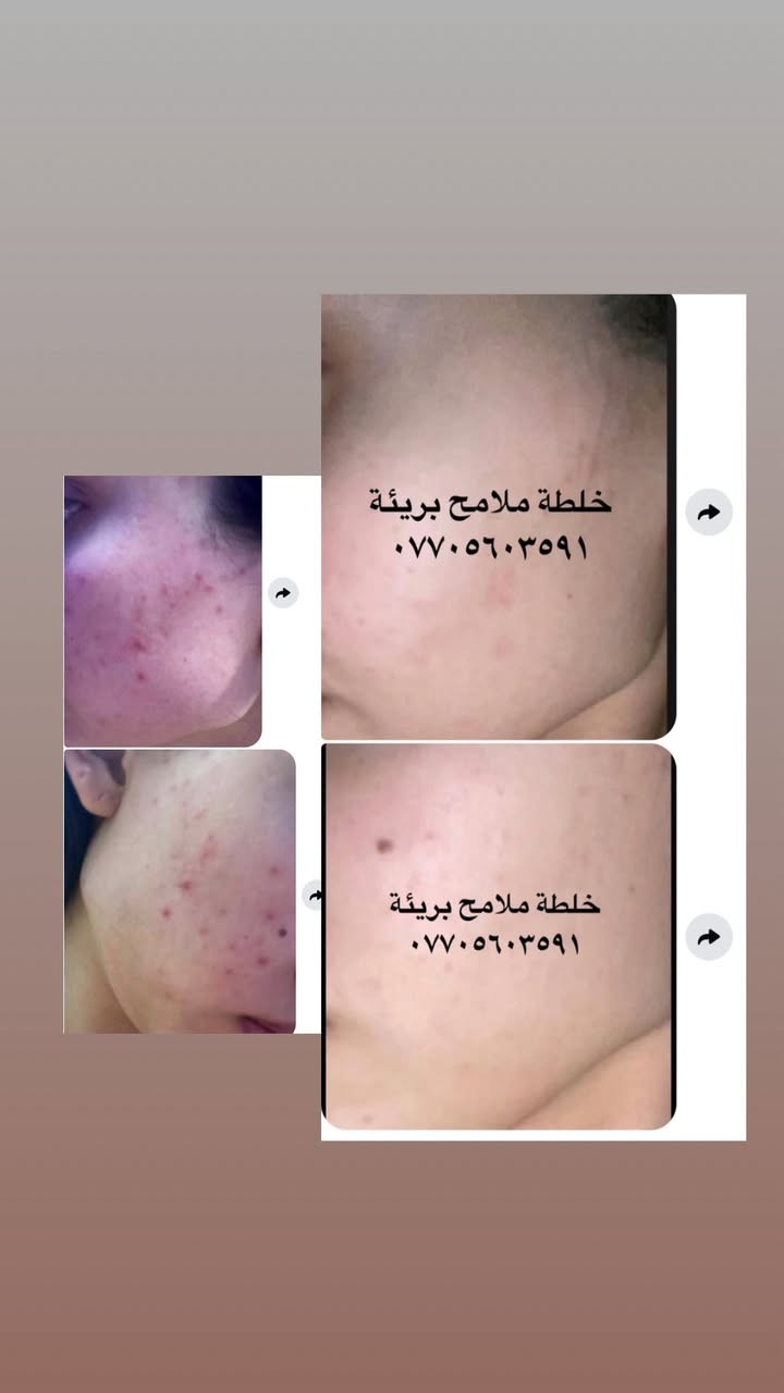 عليها القرأن الي مجربه براندي خلطة ملامح بريئة وفايدها تعلق اهنا بنات يتابعون التعليقات يردون يستخدموهاويستفسرون منكم  👈🌹


**إذا كنت صاحب هذا الإعلان وتريد حذفه لأي سبب، رجاءا أرسل رسالة إلى الدعم الفني**