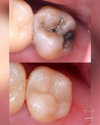 علاج مجاني • حشوة أسنان • تسوس خلفي