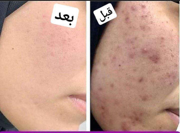 اقسم بالله العلي العظيم خلطه مجربه ومظمونه
فوائد الخلطه مع الصابونة :
1- تفتيح وتوحيد لون البشرة 
2- إزالة التصبغات و البقع السوداء
3-  تضييق المسام وتنعيم البشرة
4-  يقضي على النمش والكلف 
5- تبيض البشرة من 5 الى 7 درجة
6-ازالة حب الشباب وآثاره
  
اظافه الئ 👇

مسمن مورد ينطي امتلاء للوجه مع تبيض وتوريد شغله كلش روعه حرفيا ايجنن اضافه الئ صابونه مسمنه مورده تستخدم للوجه  وايضا تستخدم للمناطق الحساسه رووووعه 👌
*********** واتساب
