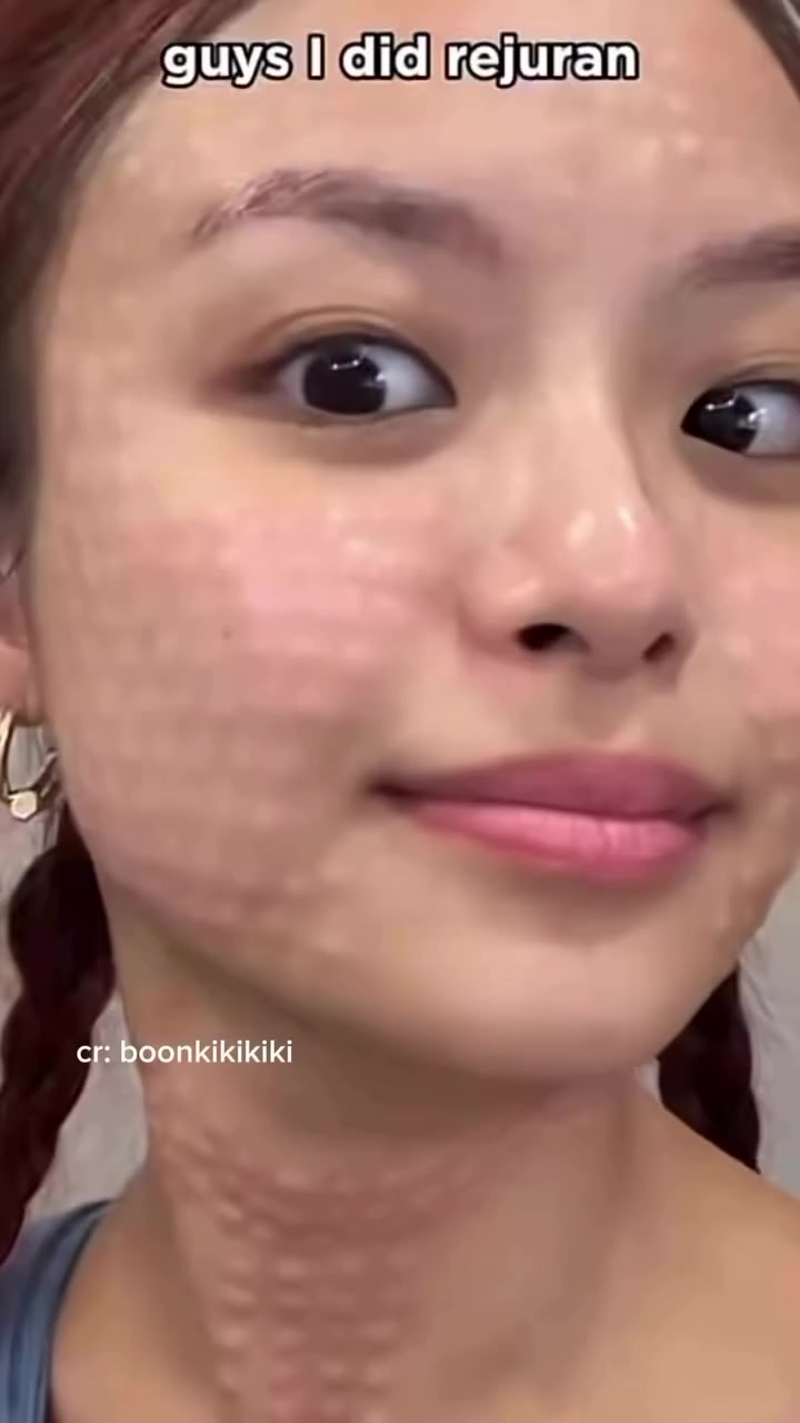 اكتشفي سر الاشراقه الكوريه مع سيروم مديكيوب الوردي الاشهر علي الاطلاق 👌🩷سي
 حان الوقت لتقديم العناية الفائقة التي تستحقها بشرتك

🔬 المكونات السحرية: قوة من أعماق البحر والطبيعة! سيروم السلمون
هذا السيروم ليس مجرد سيروم عادي، إنه تركيبة علمية متقدمة تعمل على تجديد البشرة من الداخل:
🎀  1% PDRN (Sodium DNA) 🧬: هو المكون النجمي المستخلص من سمك السلمون. يعمل على تجديد الخلايا وتسريع عملية إصلاح الجلد، مما يساعد على تحسين مرونة البشرة وملئها. إنه سر الحيوية والنضارة!
🎀  5 Types Peptide Complex 🧪: مجموعة قوية من الببتيدات التي تدعم إنتاج الكولاجين والإيلاستين، مما يقلل من ظهور التجاعيد والخطوط الدقيقة ويعزز شد البشرة.
🌸  ودّعي البشرة الباهتة والمتعبة، ومرحباً بالنتائج المذهلة!
🌸 تجديد عميق وإصلاح مكثف: يعمل على ترميم حاجز البشرة المتضرر ويمنحها مظهراً صحياً ومتكاملاً. 💪
🌸  نضارة وإشراقة وردية: يمنح البشرة توهجاً طبيعياً وإطلالة "ديوي" (نداوة) مميزة، تماماً كالزجاج! 💎
🌸  مكافحة علامات التقدم في السن: يشد البشرة ويقلل بشكل واضح من الخطوط والتجاعيد. 👵➡️👸
🌸  ترطيب وتغذية فائقة:

#السعر خاص #متوفر_الاصليييييي


**إذا كنت صاحب هذا الإعلان وتريد حذفه لأي سبب، رجاءا أرسل رسالة إلى الدعم الفني**