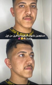 تنظيف بشره • كركوك مركز مينا • حجز بالاتصال