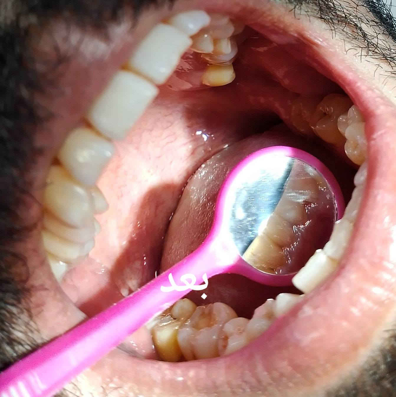 🦷 قبل وبعد تنظيف الأسنان وإزالة التكلسات 

إحدى الحالات التي تم العمل عليها داخل العيادات التعليمية

الفرق واضح في الوظيفة والمظهر 👌

🔹 الخدمات المتوفرة حاليًا (مجاني ):
• حشوات تجميلية ضوئية
• قلع الأسنان
• عمل طقم متحرك
• تنظيف الأسنان وإزالة التكلسات

📍 العمل يتم داخل العيادات وتحت إشراف مختصين

📱 للحجز والتواصل واتساب: (0770 984 7469)

#طبيب #اسنان # اكسبلور #فولو #لايك #تعليق
