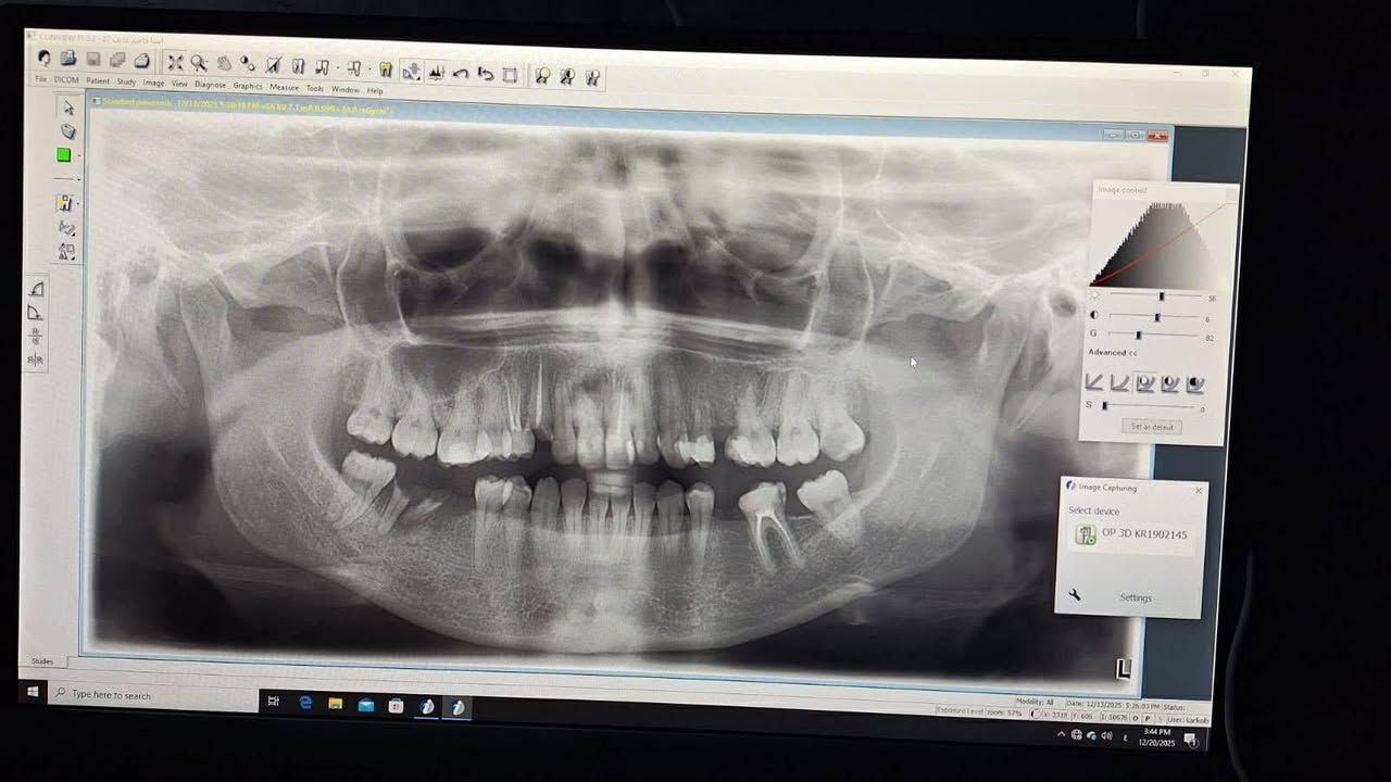 السلام عليكم متوفر للبيع نظيف جدا

OPG  شركة KAVO CARE الالمانية 2019
كامل مع الحاسبة والطابعة وبالامكان تحويل cbct

للاستفسار. م احمد 
***********
