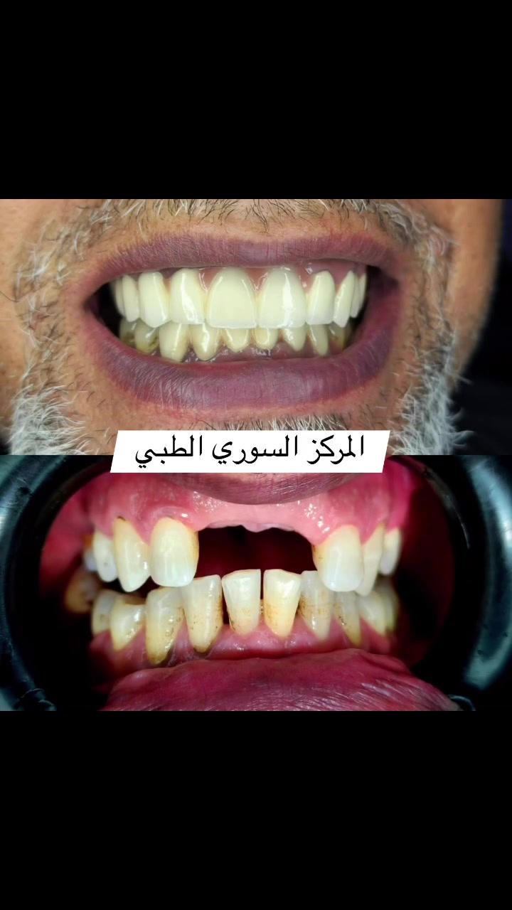 ابتسم دائماً ❤️
الشغل الصح ✅ بالمكان الصح✅🫡

(زراعة-تقويم-تغليف-تركيب)

#ملاحظة ضمان مدى الحياةأدواتنا استخدام واحد فقط

المياه المستخدمة أثناء المعالج معقمة(كاسات) 

للحجز والاستفسار مراسلة الصفحة أو الاتصال على الأرقام التالية ☎️*********** _***********

#اسنان #زراعة #تقويم #تغليف
#المحمودية #بغداد #مدينة_الصدر

تيك توك 👇👇👇
￼https://www.tiktok.com/@mstk520?_t=ZS-8vKXPDhbuIm&_r=1

انستا 👇👇👇
https://www.instagram.com/lmrkzlswryltby/
profilecard/?igsh=Y2d5ODJ5Z3YwNWl3
