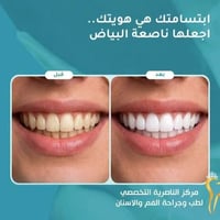 فينير • تراكيب أسنان • المنصورية