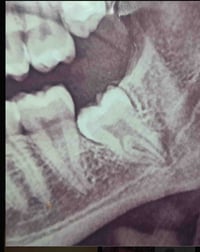 اللي عنده هيج سن مطمور ويريد يقلعه يراسلني والعلاج مجاني من قبل دكتور ...