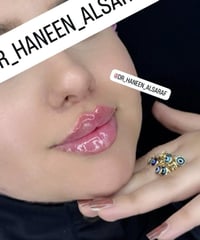 فيلر بوتوكس • خطوط ضاحكة • الكوت