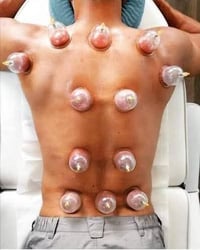 💪 علاج إصابات العضلات بالحجامة 💪  هل تعاني من: ❌ شد عضلي ❌ تمزق عضلي ❌...