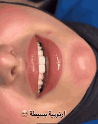 احلى من يبتسم …🦷❤️🙂‍↔️

ابتسامة أرنبية وبلون ابيض طبيعي 

الابتسامة نوع زيركون ودائمية مع الضمان 💯♥️
.
.
.
عنوان العيادة 🦷🤍✨

الرمادي _شارع المستودع _مجمع النخبة الطبي 
مبنى المحافظة مقابيل الضريبة القديمة مباشرة
 

للحجز والاستفسار الاتصال ع الرقم: ***********
او مراسلة صفحة العيادة 

أوقات الدوام من الساعة من ١١ صباحاإلى الساعة ٩ ليلا
