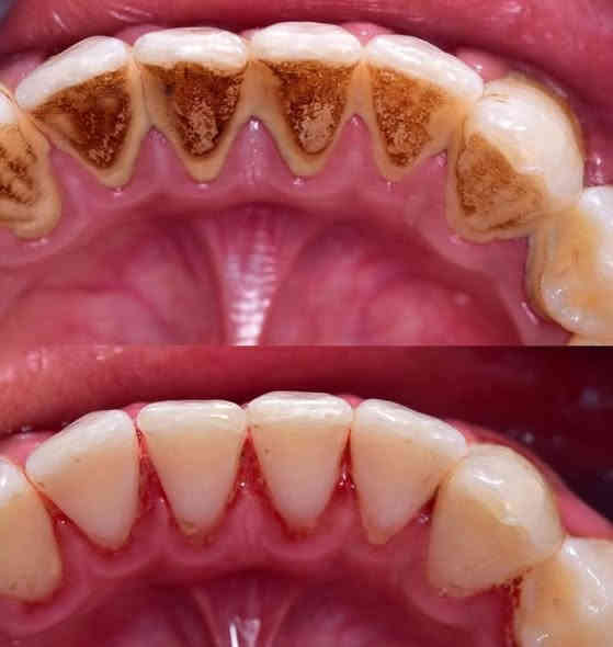 السلام عليكم 
تعاني من ألم ، تسوس ، أو تحتاج تنظيف للأسنان وازالة التكلسات ؟

عيادات جامعة كلكامش تقدّم لك علاج مجاني ويشمل  :

- تنظيف عميق وإزالة التكلسات

- حشوات تجميلية

- قلع الأسنان المتحركة أو الجذور التالفة عند الضرورة

- طقم جزئي متحرك لتعويض الأسنان المفقودة

- تشخيص دقيق وخطة علاج كاملة

✔️ شغل نظيف وآمن
✔️ أدوات معقمة
✔️ متابعة كاملة لحالتك

📍 العنوان: الدورة - حي الصحة - عيادات جامعة كلكامش (مجمع نون والقلم)

للحجز والاستفسار : ***********
راسلوني واتساب او على الخاص  🤍

د. زهراء علاء
