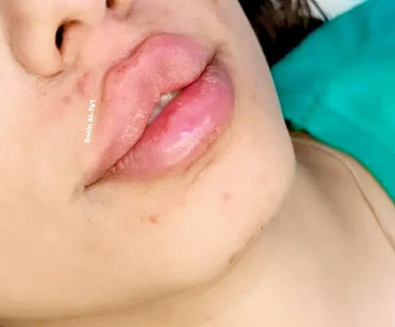 قبل وبعد الحقن لكيكتي شوفو جمال الرسمه الكرزية الروسي 😌👑

كل هذا جمال 75 الف بس


**إذا كنت صاحب هذا الإعلان وتريد حذفه لأي سبب، رجاءا أرسل رسالة إلى الدعم الفني**