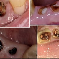 مجاناً • قلع أسنان • طقم أسنان مجاني