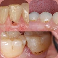 علاج تسوس مجاني • قلع اسنان • كربلاء حي النقيب