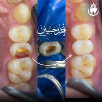 حشوة جذر • حشوة تجميلية • أحمد الطعماوي