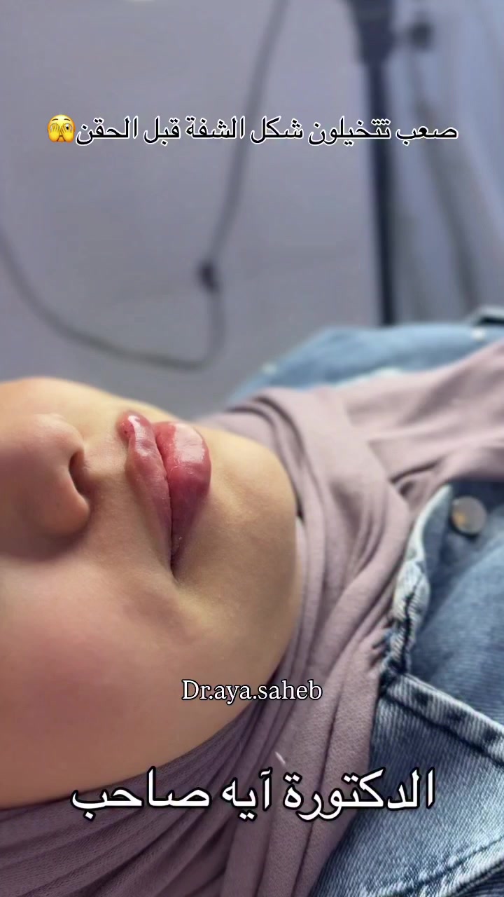 نوع الفلر سويسري 
للحجز والاستفسار/***********
الديوانية 📍#فلر_شفايف #فلر #الديوانية #تجميل #اكسبلور
