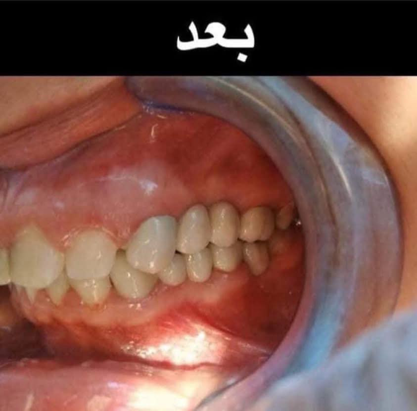 اللي يريد يحجز يتصل او يدز عالخاص 

عيادة طب الاسنان 
تقويم الاسنان ،، زراعة الاسنان ،، حشوات تجميلية
تركيب الاسنان (سيراميك و زارگون)،، حشوات جذور ،، قلع،، حشوات مؤقتة ودائمية ،، تنظيف وتلميع الاسنان ،، تبييض الاسنان بالليزر 
متواجدين طيلة أيام الاسبوع 
للحجز والاستفسار ع الخاص او ع الرقم 
*********** واتساب 
العنوان .. الامين الثانية شارع البنازيخانة يم السوگ 
قریب ع افران السلام واسواق الشارقة مقابل محلات الصبيحاوي
مجمع دكتورة رجاء محمد نصيري
